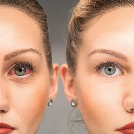 Conjunctivitis
