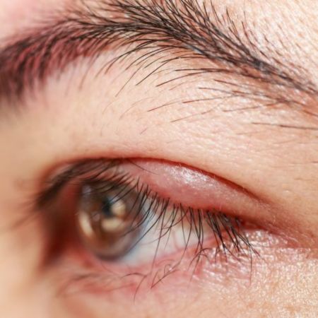 Chalazion