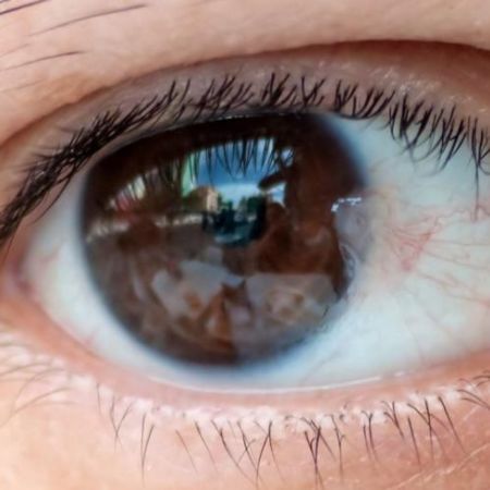 Pterygium