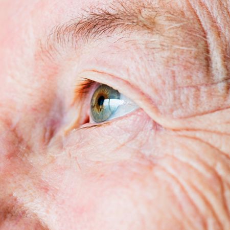 Age-related Macular Degeneration (AMD)