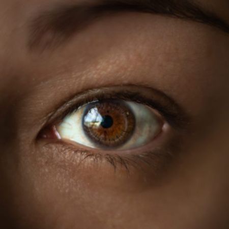 Keratoconus
