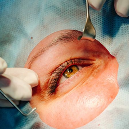 Corneal Transplant