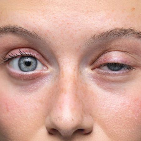 Eyelid Correction Surgery