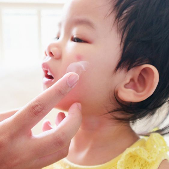 Eksim (Dermatitis)