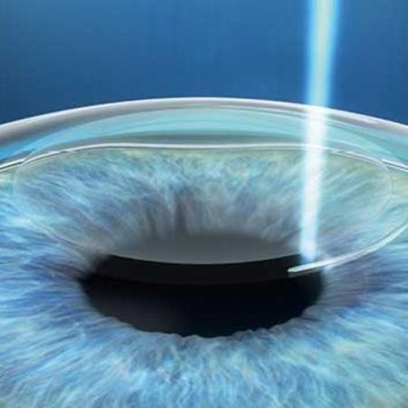 ZEISS SMILE®