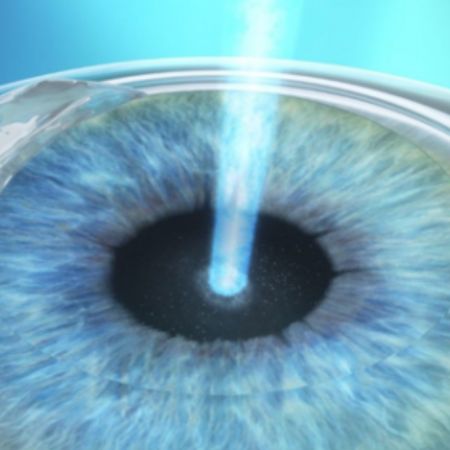 Photo-Refractive Keratectomy (PRK)